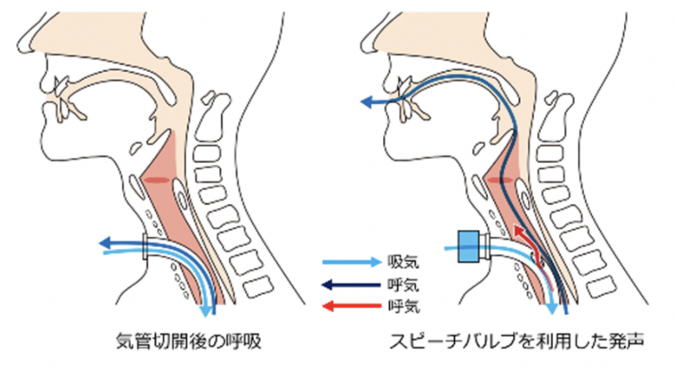 口咽頭エアウェイ
