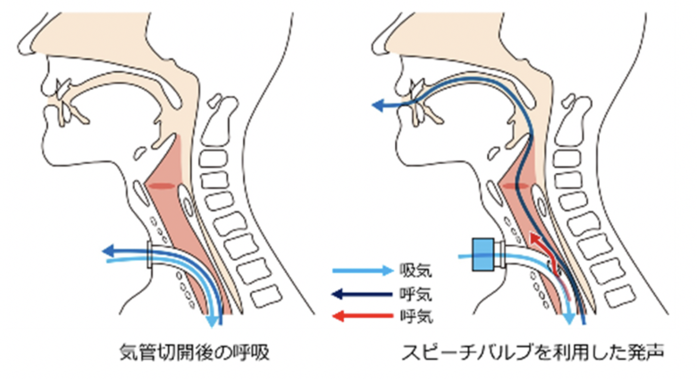 お役立ち情報					気管切開しても発声できる方法とは