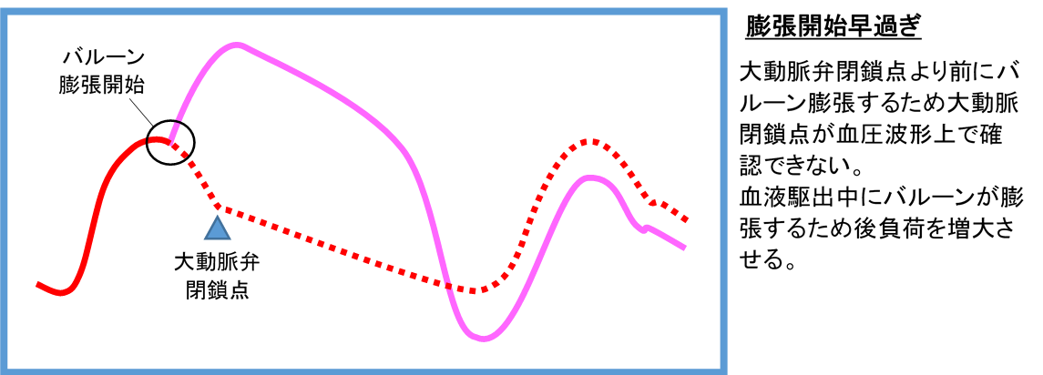 バルーン膨張タイミング早い