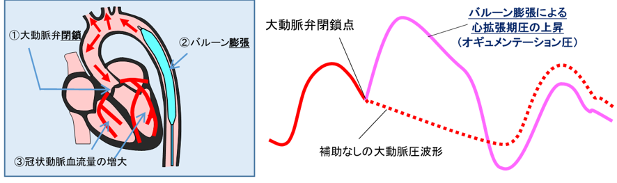 バルーン膨張タイミング