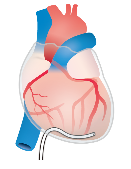 心嚢ドレーン