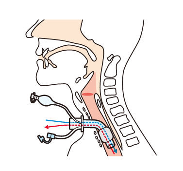 気管切開しても発声できる方法とは Mera 泉工医科工業株式会社 医療と共に歩む 信頼のメラ製品