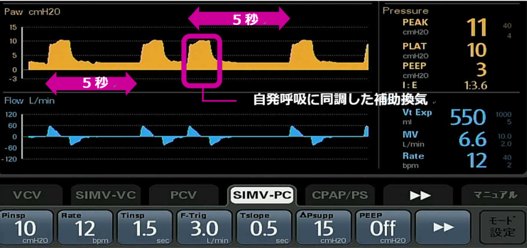 実は便利⁉ SIMVモードについて - MERA 泉工医科工業株式会社 ―医療と共に歩む、信頼のメラ製品―