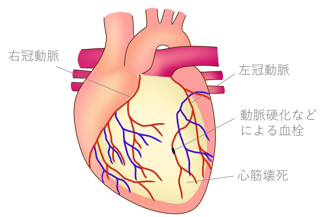 【送料無料/新品】 冠動脈疾患と治療法 ―医療と共に 泉工医科工業株式会社 MERA - 医学一般